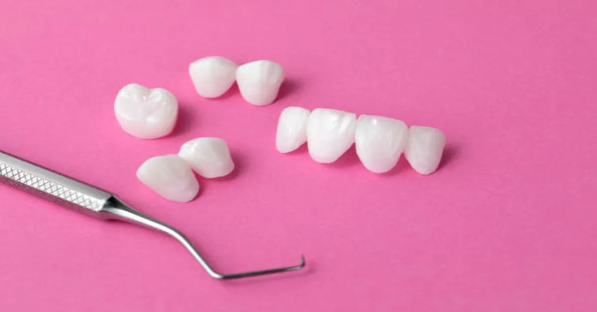 Dental Veneers for Missing Teeth